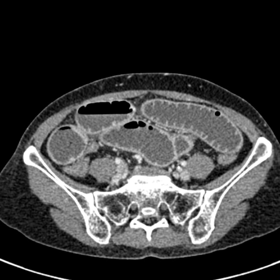 Adhesional small bowel obstruction (Radiopaedia 48397-53305 Axial C+ portal venous phase 65).jpg