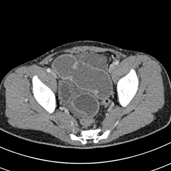 File:Adhesional small bowel obstruction (Radiopaedia 52107-57980 Axial C+ portal venous phase 111).jpg