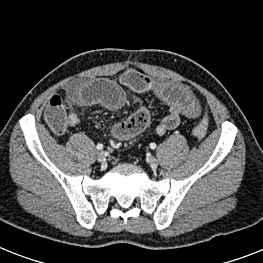 Adhesional small bowel obstruction (Radiopaedia 58900-66131 Axial C+ portal venous phase 40).jpg
