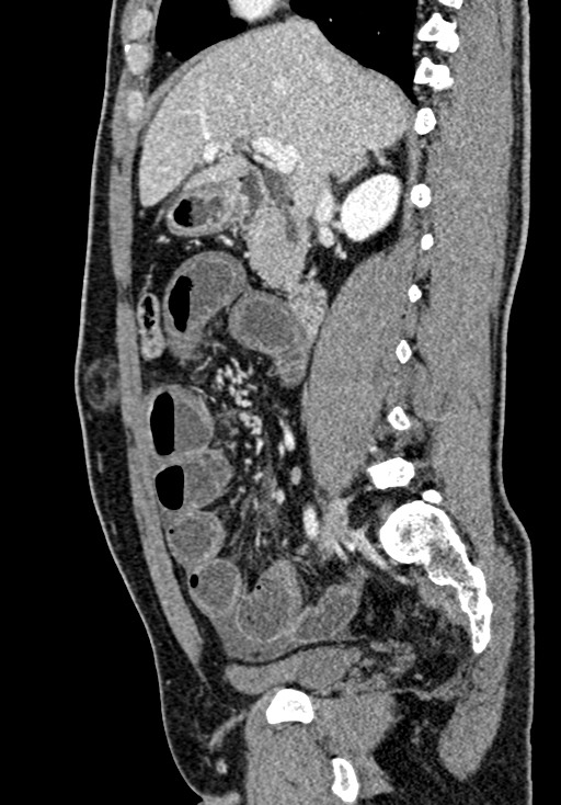 Adhesional small bowel obstruction (Radiopaedia 58900-66131 Sagittal C+ portal venous phase 100).jpg