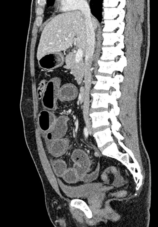 Adhesional small bowel obstruction (Radiopaedia 58900-66131 Sagittal C+ portal venous phase 113).jpg