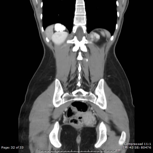 File:Adrenal calcification (Radiopaedia 55755-62314 Coronal C+ portal venous phase 32).jpg