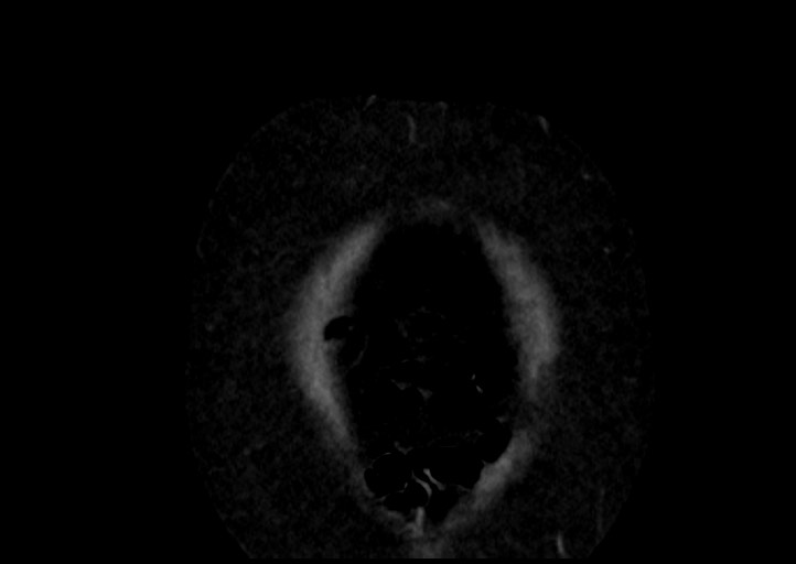 Adrenal cortical carcinoma (Radiopaedia 64017-72769 Coronal C+ portal venous phase 1).jpg