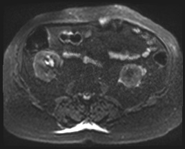 Adrenal cortical carcinoma (Radiopaedia 64017-72770 Axial DWI 76).jpg