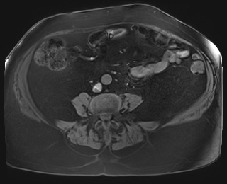 Adrenal cortical carcinoma (Radiopaedia 64017-72770 Axial T1 fat sat 68).jpg