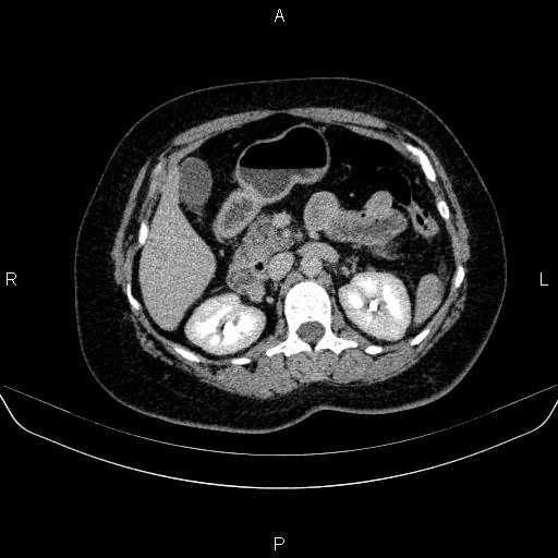 Adrenal cortical carcinoma (Radiopaedia 84882-100379 Axial C+ delayed 31).jpg