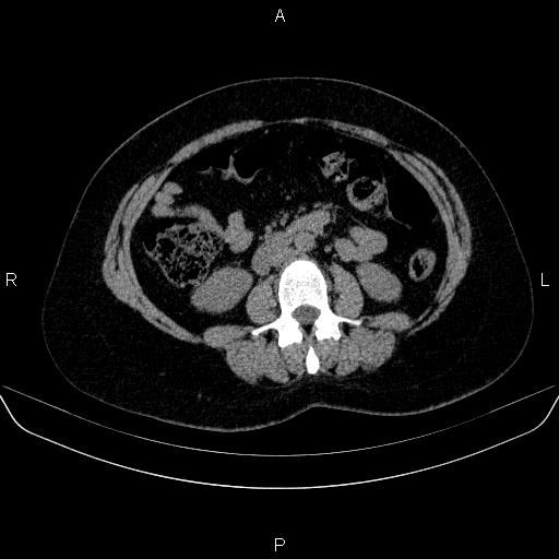File:Adrenal cortical carcinoma (Radiopaedia 84882-100379 Axial non-contrast 45).jpg