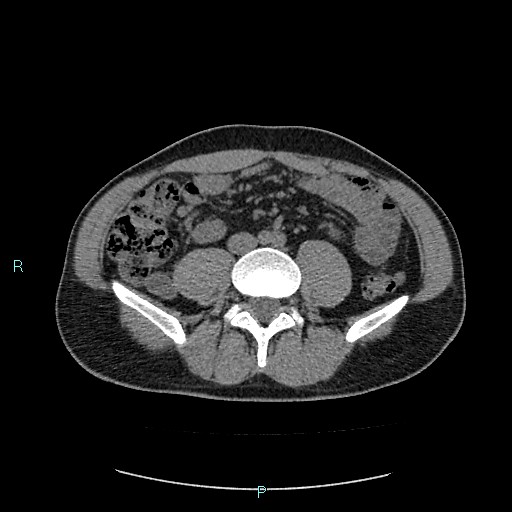 Adrenal cystic lymphangioma (Radiopaedia 83161-97534 Axial non-contrast 59).jpg