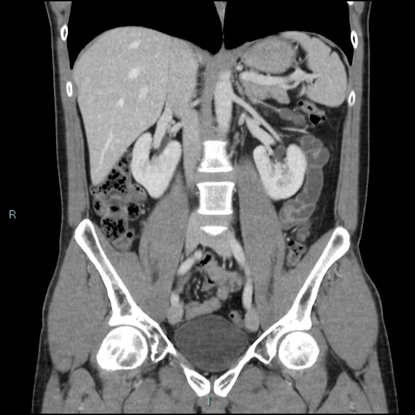 Adrenal cystic lymphangioma (Radiopaedia 83161-97534 Coronal C+ portal venous phase 39).jpg