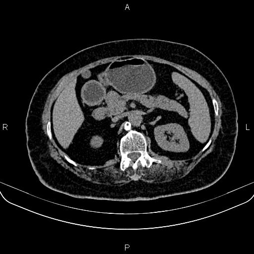 Adrenal myelolipoma (Radiopaedia 82742-96986 Axial non-contrast 55).jpg