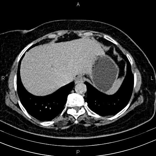 Adrenal myelolipoma (Radiopaedia 82742-96986 Axial renal excretory phase 9).jpg