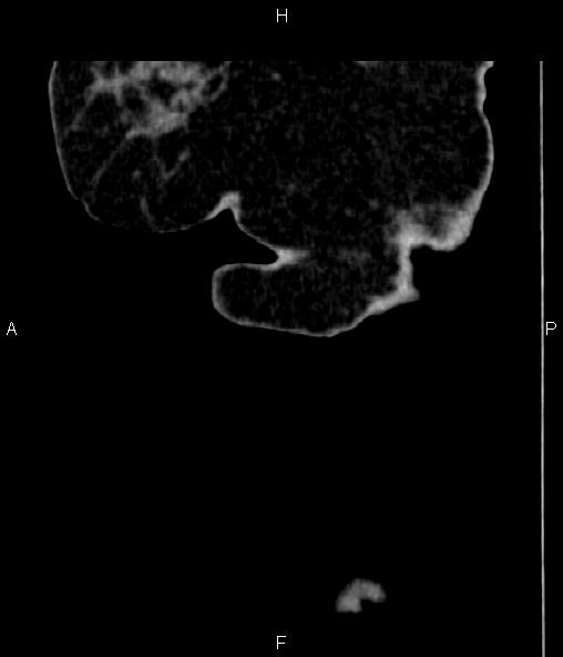 Adrenal myelolipoma (Radiopaedia 82742-96986 Sagittal renal cortical phase 1).jpg