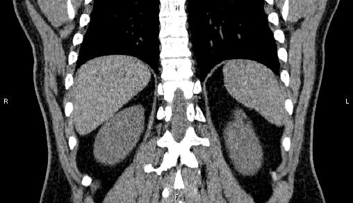 Adrenal myelolipoma (Radiopaedia 84321-99619 Coronal non-contrast 62).jpg