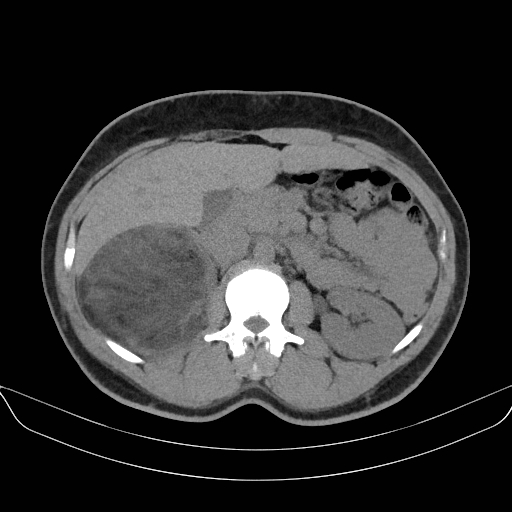 File:Adrenal myelolipoma - bilateral (Radiopaedia 74805-85810 Axial non-contrast 29).jpg