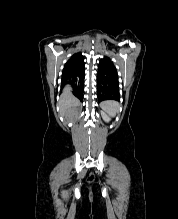 Adrenocortical carcinoma (Radiopaedia 80134-93438 Coronal C+ portal venous phase 134).jpg