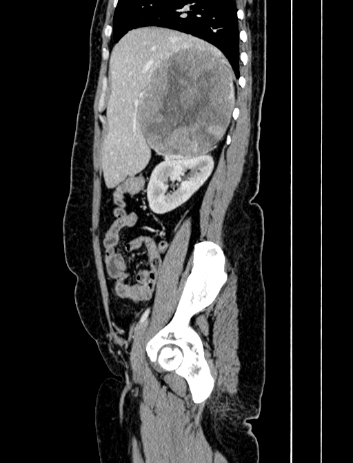Adrenocortical carcinoma (Radiopaedia 87281-103569 Sagittal C+ portal venous phase 78).jpg