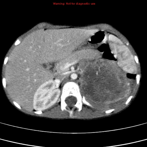 File:Adrenocortical carcinoma (Radiopaedia 9449-10131 Axial C+ portal venous phase 18).jpg