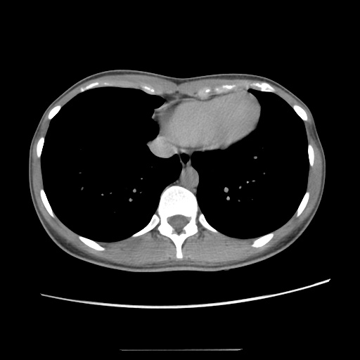Adult polycystic kidney disease (Radiopaedia 48845-53876 Axial renal excretory phase 12).jpg