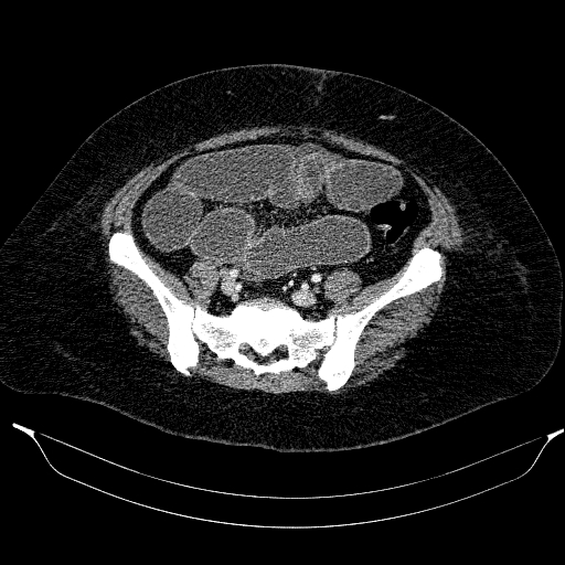 Afferent loop syndrome - secondary to incarcerated trocar site hernia (Radiopaedia 82959-97305 Axial C+ portal venous phase 174).jpg