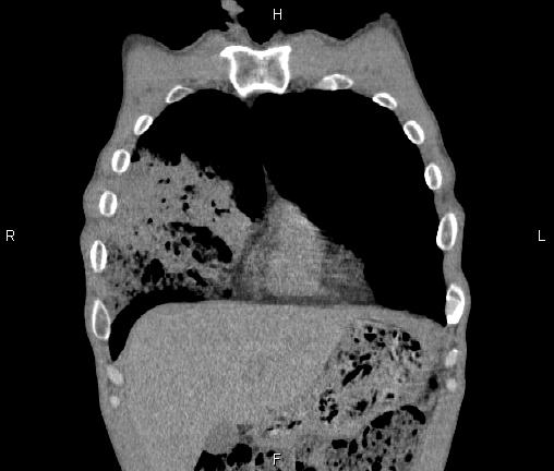Air bronchogram in pneumonia (Radiopaedia 85719-101512 Coronal non-contrast 10).jpg