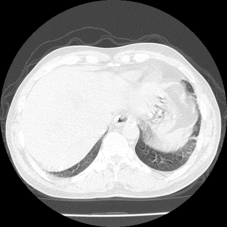 Airway foreign body in adult (Radiopaedia 85907-101779 Axial lung window 168).jpg