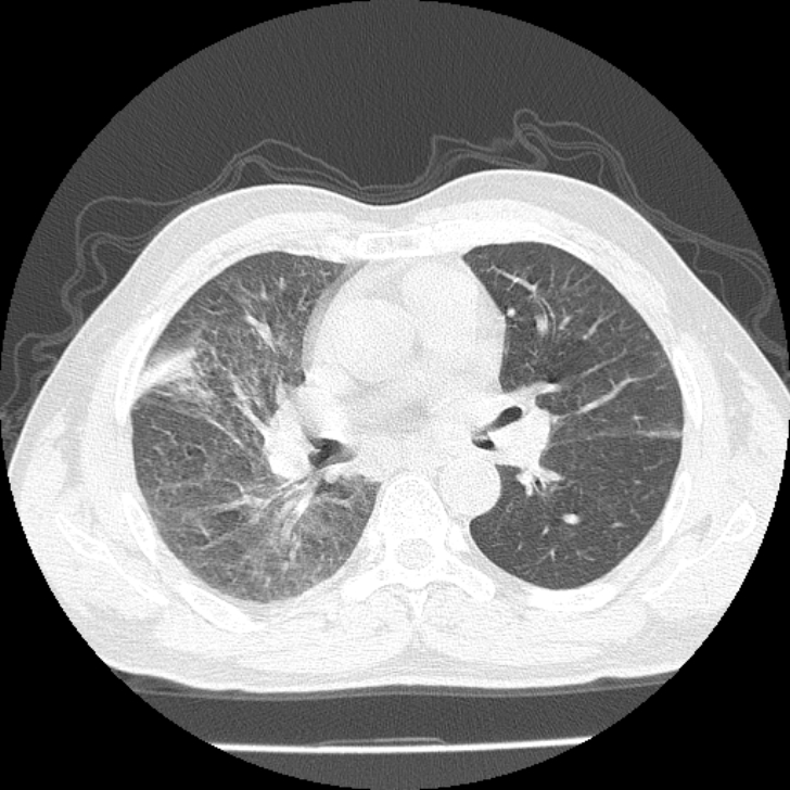 Airway foreign body in adult (Radiopaedia 85907-101779 Axial lung window 79).jpg