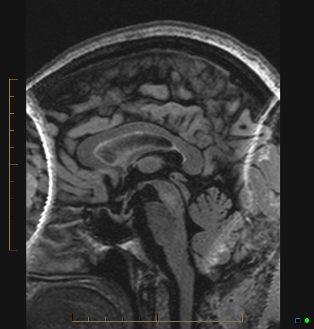 Aliasing artifact causing a spurious cerebellar lesion (Radiopaedia 48783-53810 Sagittal FLAIR 45).jpg