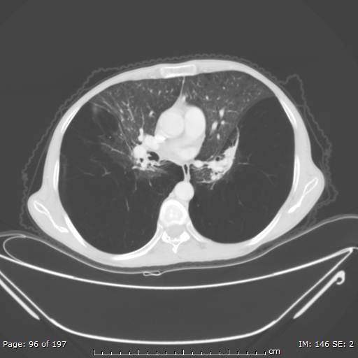 File:Alpha-1-antitrypsin deficiency (Radiopaedia 50561-55987 Axial lung window 40).jpg