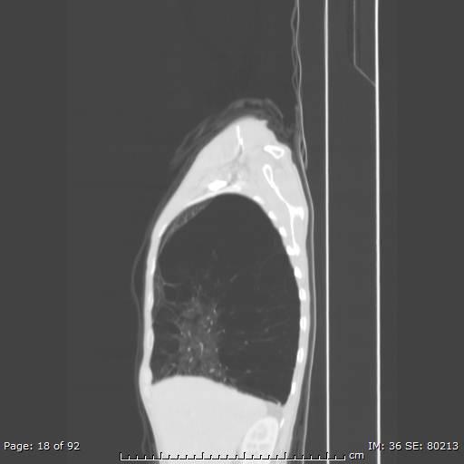 File:Alpha-1-antitrypsin deficiency (Radiopaedia 50561-55987 Sagittal lung window 9).jpg