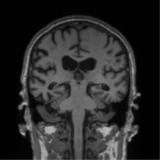 File:Alzheimer's disease- with Gerstmann syndrome and dressing apraxia (Radiopaedia 54882-61150 Coronal T1 38).png