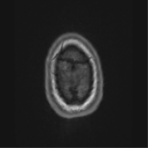 Alzheimer's disease- with apraxia (Radiopaedia 54763-61011 Axial T1 75).png