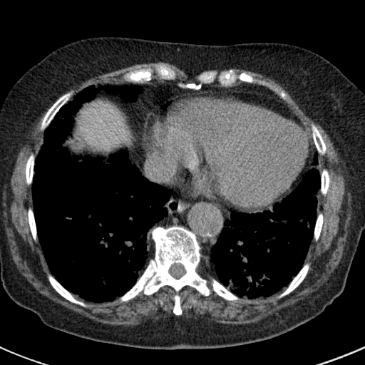 File:Amiodarone-induced pulmonary fibrosis (Radiopaedia 82355-96460 Axial non-contrast 44).jpg