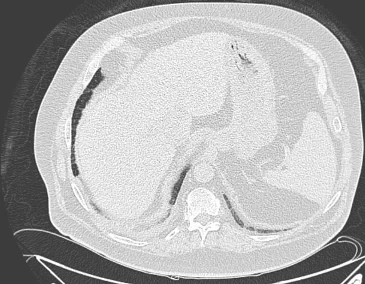 Amiodarone lung (Radiopaedia 62514-70769 Axial lung window 78).jpg