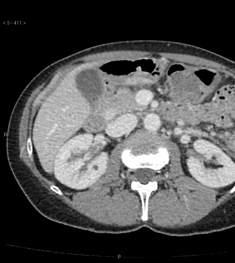 Ampulla of Vater metastasis (Radiopaedia 27820-28065 A 15).jpg