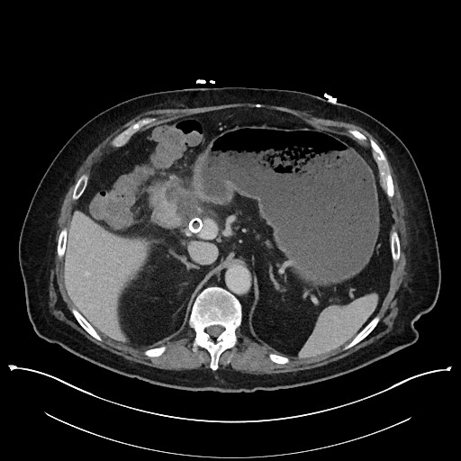 Ampullary adenocarcinoma (Radiopaedia 59373-66737 A 50).jpg
