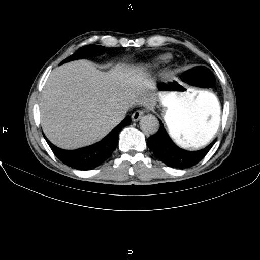 File:Ampullary adenocarcinoma (Radiopaedia 86093-102032 Axial C+ delayed 12).jpg