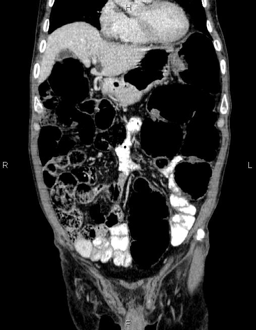 Ampullary adenocarcinoma (Radiopaedia 86093-102032 C 19).jpg