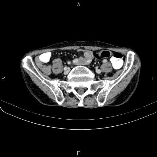 Ampullary adenocarcinoma (Radiopaedia 86093-102033 B 90).jpg