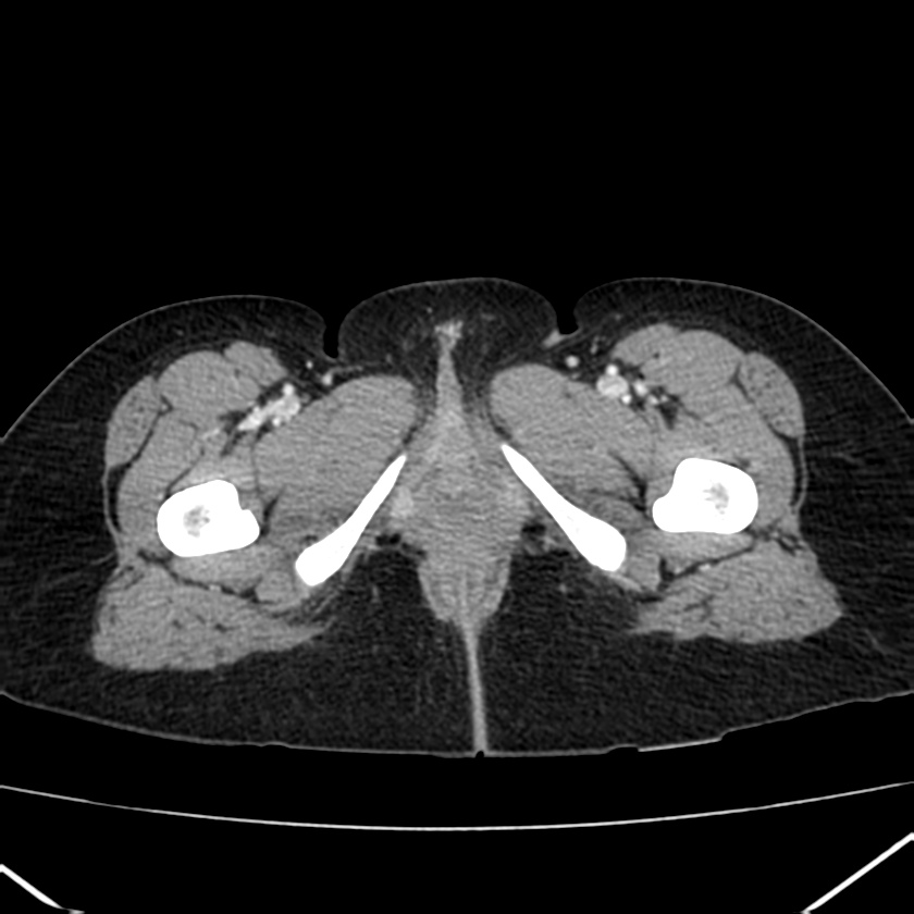 Ampullary tumor (Radiopaedia 22787-22816 C 76).jpg