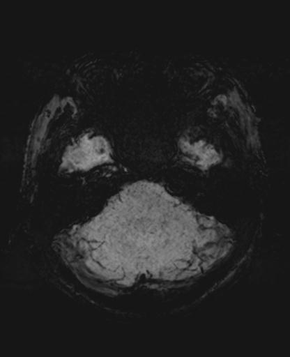 File:Amyloid angiopathy with inflammation (Radiopaedia 30360-31002 Axial SWI MIP 6).jpg