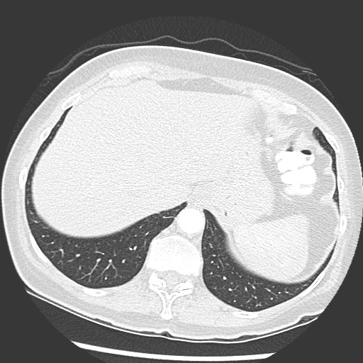 Amyloidosis - bronchial and diffuse nodular pulmonary involvement (Radiopaedia 60156-67745 Axial lung window 75).jpg