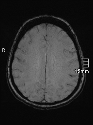 Amyotrophic lateral sclerosis (Radiopaedia 70821-81017 Axial SWI 37).jpg