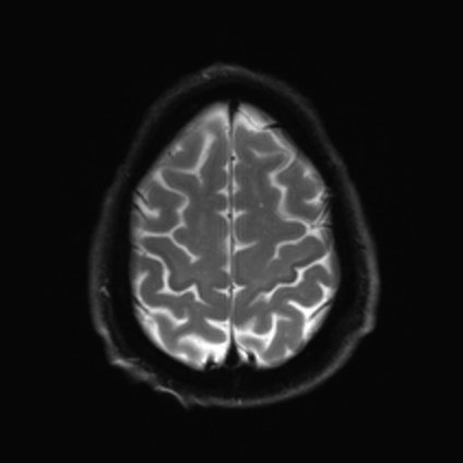 File:Amyotrophic lateral sclerosis (Radiopaedia 87352-103658 Axial DWI 24).jpg