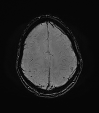 File:Anaplastic astrocytoma IDH mutant (Radiopaedia 50046-55341 Axial SWI 70).png