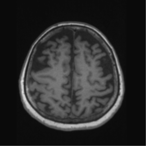 Anaplastic astrocytoma IDH wild-type (pseudoprogression) (Radiopaedia 42209-45276 Axial T1 112).png