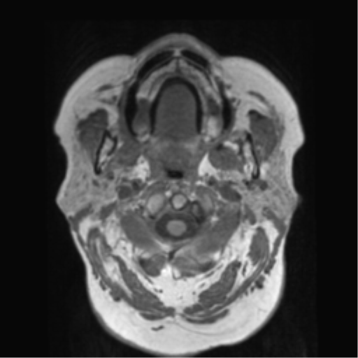 File:Anaplastic astrocytoma IDH wild-type (pseudoprogression) (Radiopaedia 42209-45278 Axial T1 9).png