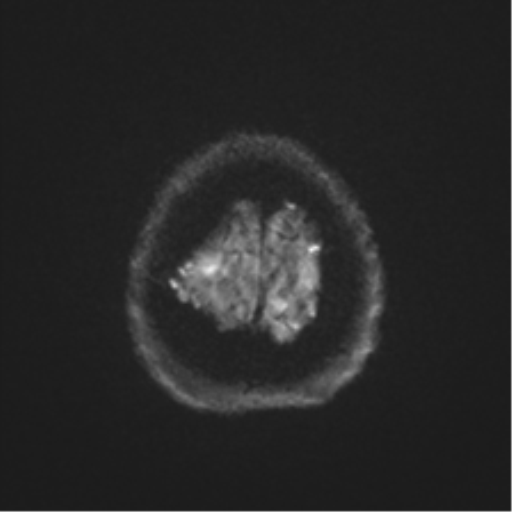 Anaplastic astrocytoma IDH wild-type (pseudoprogression) (Radiopaedia 42209-45279 Axial DWI 53).png