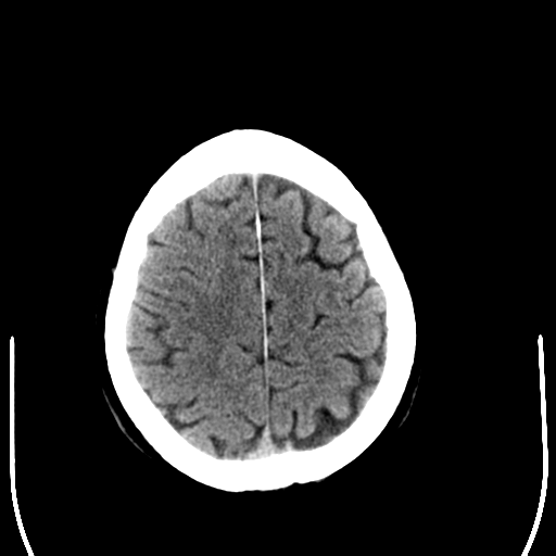 File:Anaplastic meningioma with recurrence (Radiopaedia 34452-35781 Axial non-contrast 27).png