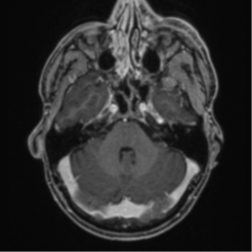 Anaplastic oligodendroglioma with skull fracture (Radiopaedia 74831-85845 Axial T1 C+ fat sat 13).png