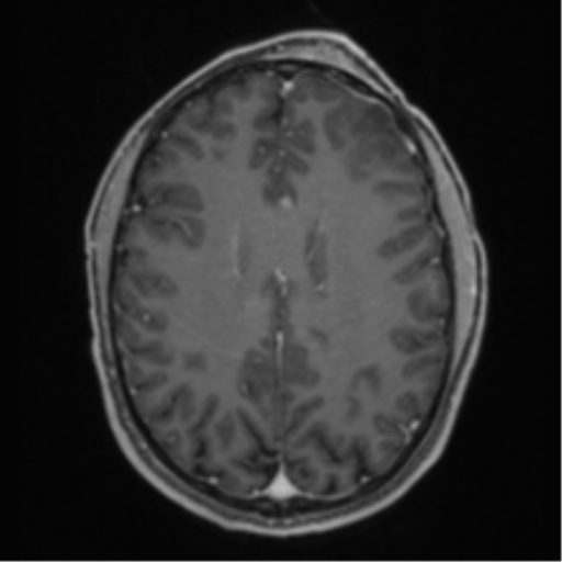 Anaplastic oligodendroglioma with skull fracture (Radiopaedia 74831-85845 Axial T1 C+ fat sat 41).png
